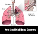 Các thuốc ức chế Tyrosine Kinase trong ung thư phổi không tế bào nhỏ: Chỉ định hiện tại và triển vọng trong tương lai!